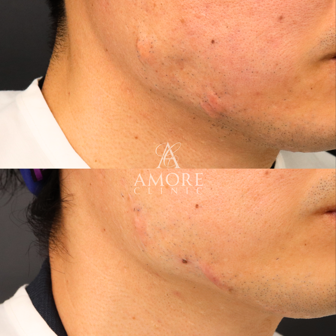 ケロイド除去（切開法）