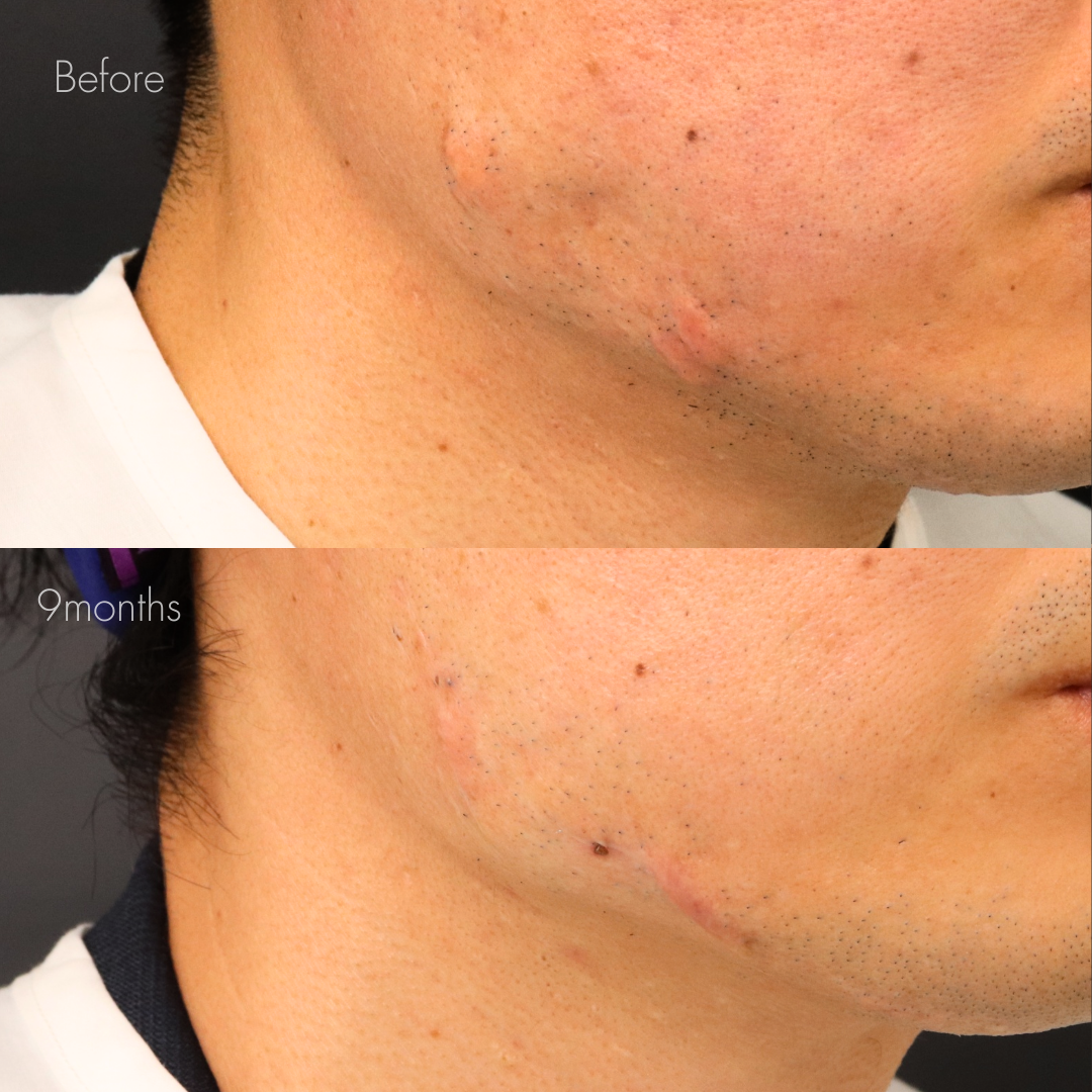 ケロイド除去（切開法）