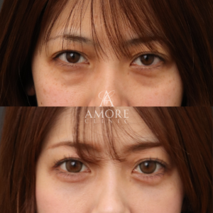 下眼瞼脱脂 （結膜側）＋涙袋ヒアルロン酸