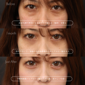 下眼瞼脱脂 （結膜側）＋涙袋ヒアルロン酸