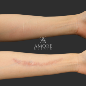 リストカットの傷跡修正（切開法）