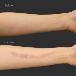 リストカットの傷跡修正（切開法）