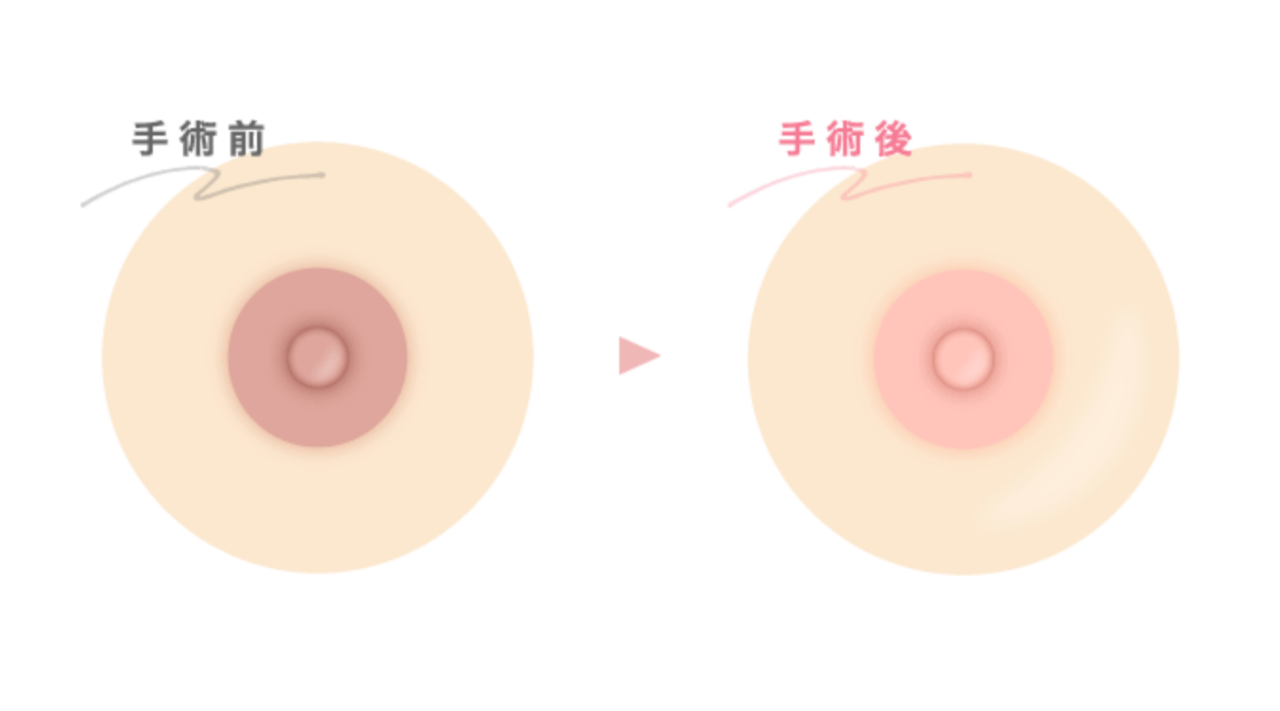 ニップルトーニング