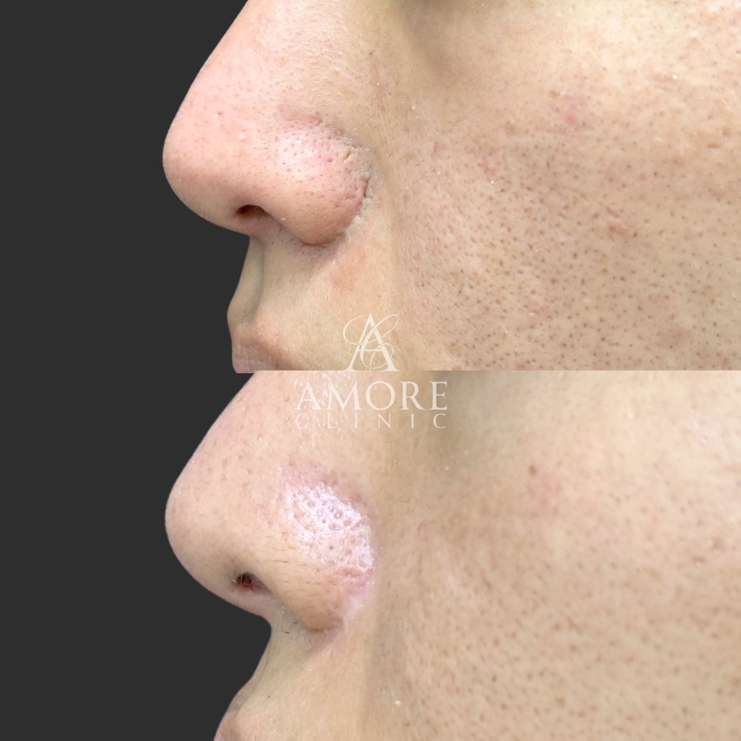 鼻翼縮小後の傷跡修正（切開法）