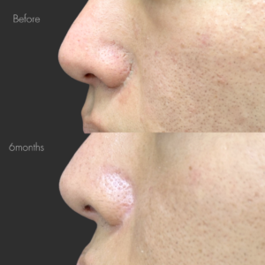 鼻翼縮小後の傷跡修正（切開法）