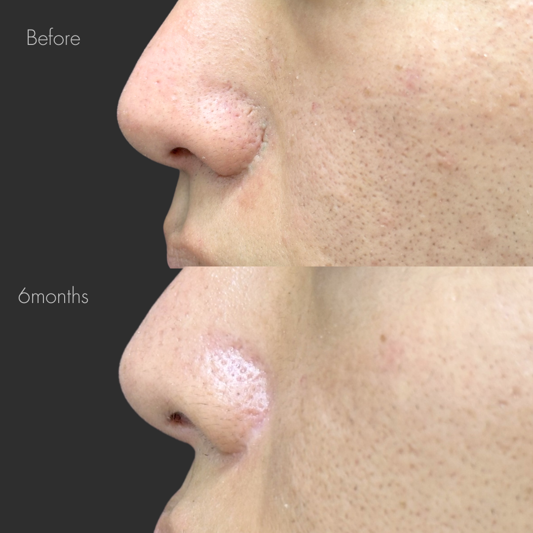 鼻翼縮小後の傷跡修正（切開法）