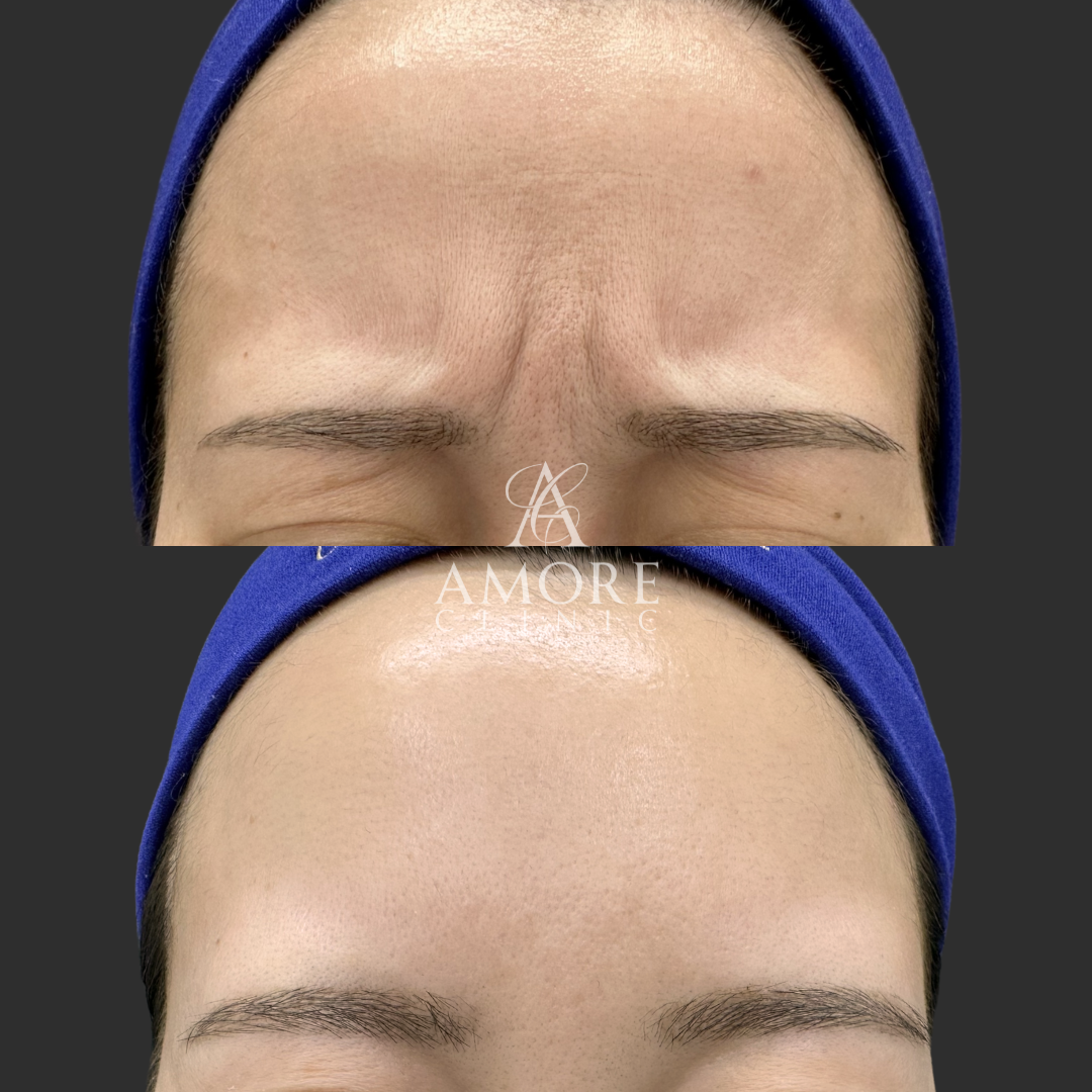 眉間ボトックス