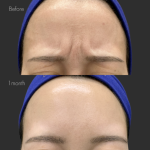 眉間ボトックス