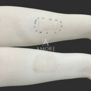 リストカットの傷跡修正（植皮法）