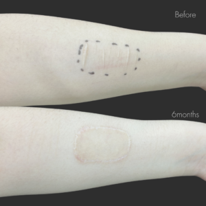 リストカットの傷跡修正（植皮法）