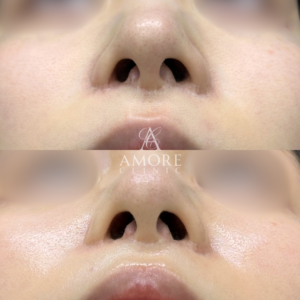 人中短縮後の傷跡修正（グラデーション加工）