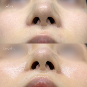 人中短縮後の傷跡修正（グラデーション加工）