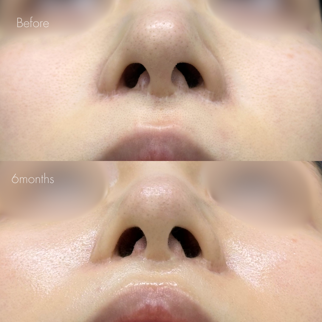 人中短縮後の傷跡修正（グラデーション加工）