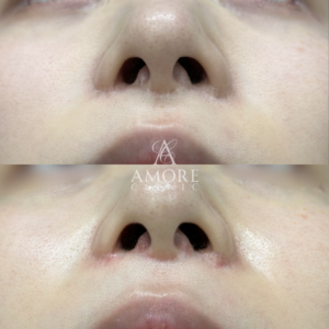 鼻翼縮小後の傷跡修正（グラデーション加工）