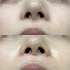 鼻翼縮小後の傷跡修正（グラデーション加工）