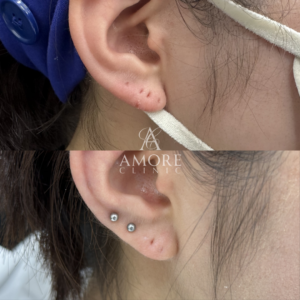 ピアス穴修正（切開法）