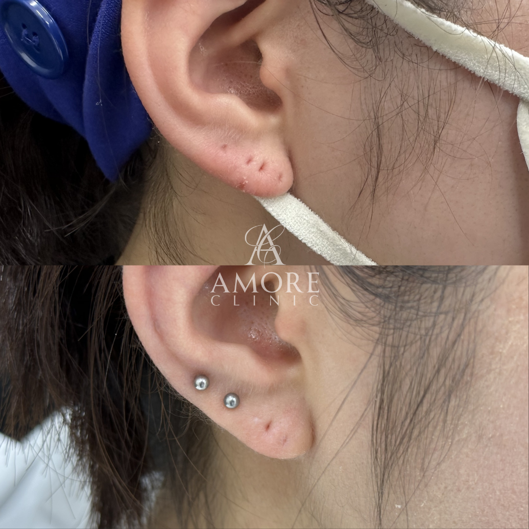 ピアス穴修正（切開法）