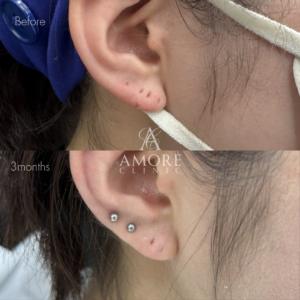 ピアス穴修正（切開法）