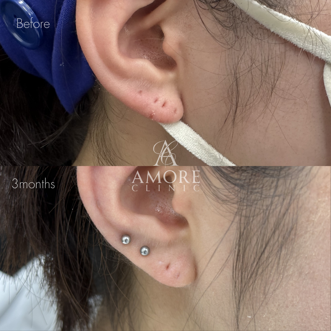 ピアス穴修正（切開法）