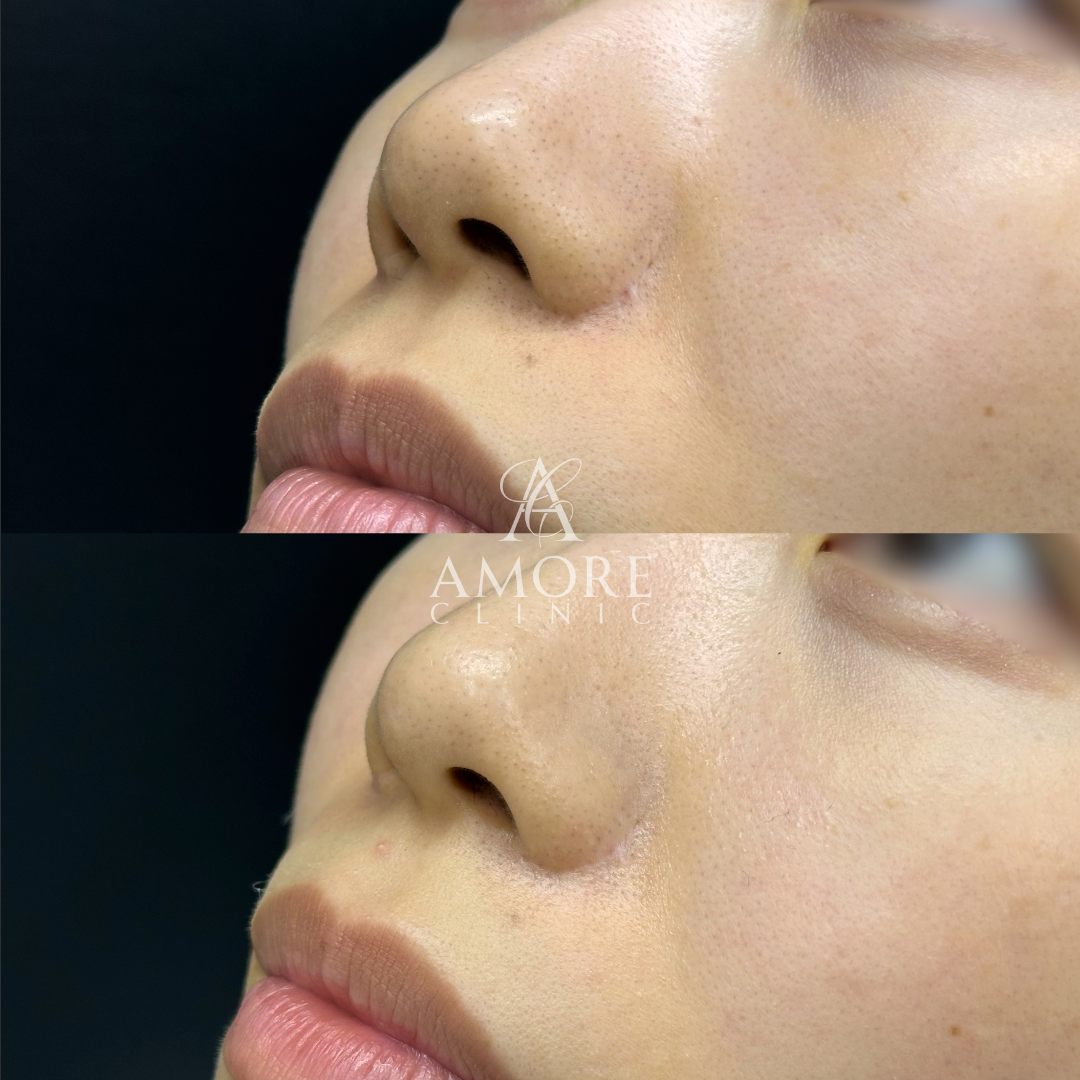 鼻翼縮小後の傷跡修正（グラデーション加工）