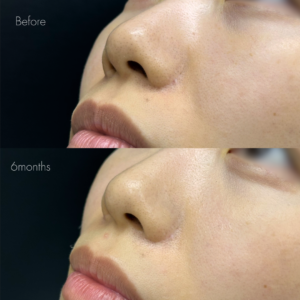 鼻翼縮小後の傷跡修正（グラデーション加工）