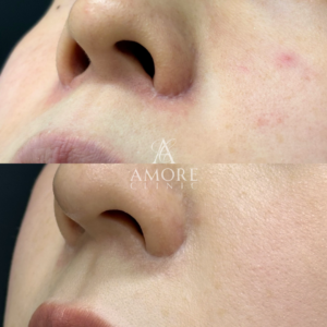 鼻翼縮小後の傷跡修正（グラデーション加工）