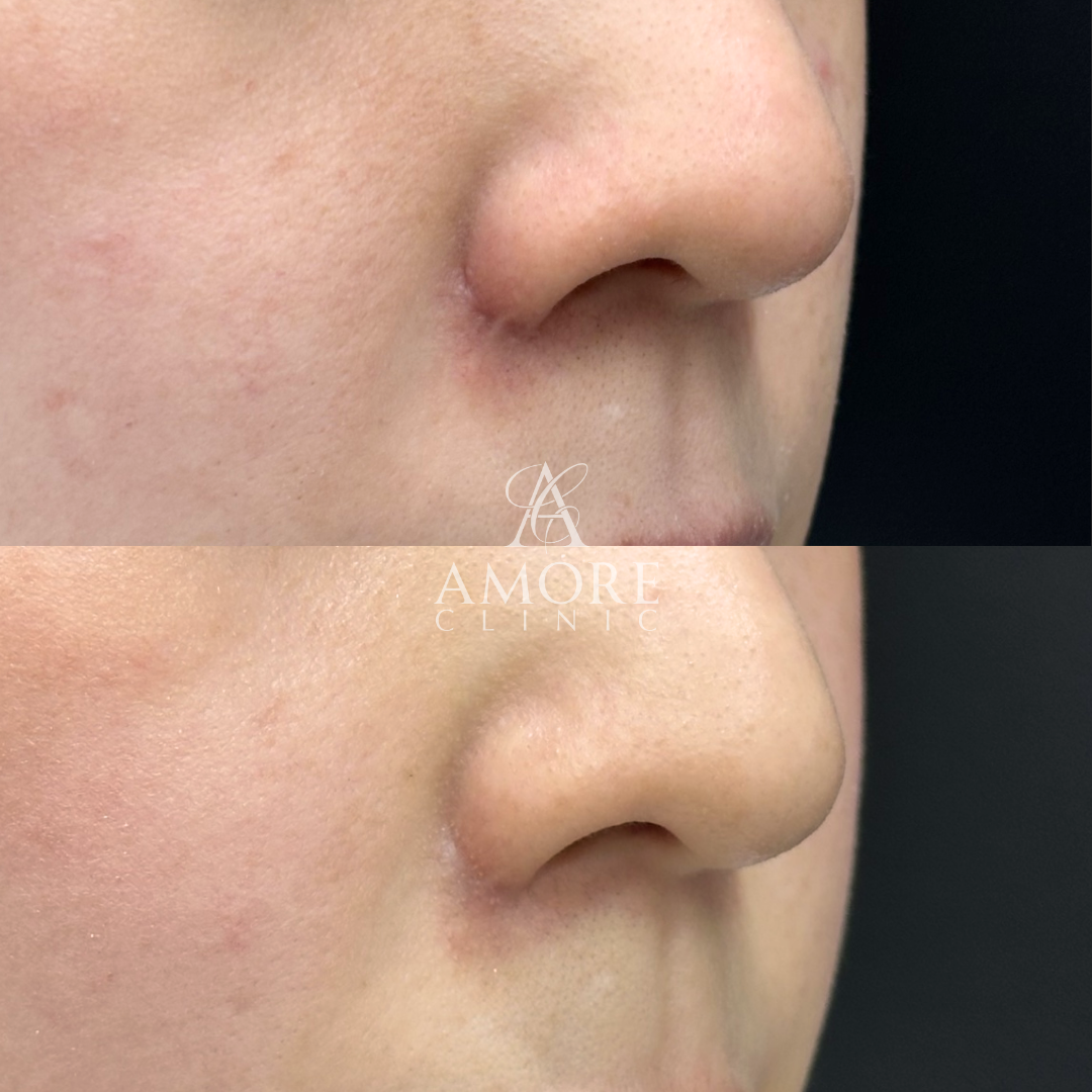 鼻翼縮小後の傷跡修正（グラデーション加工）