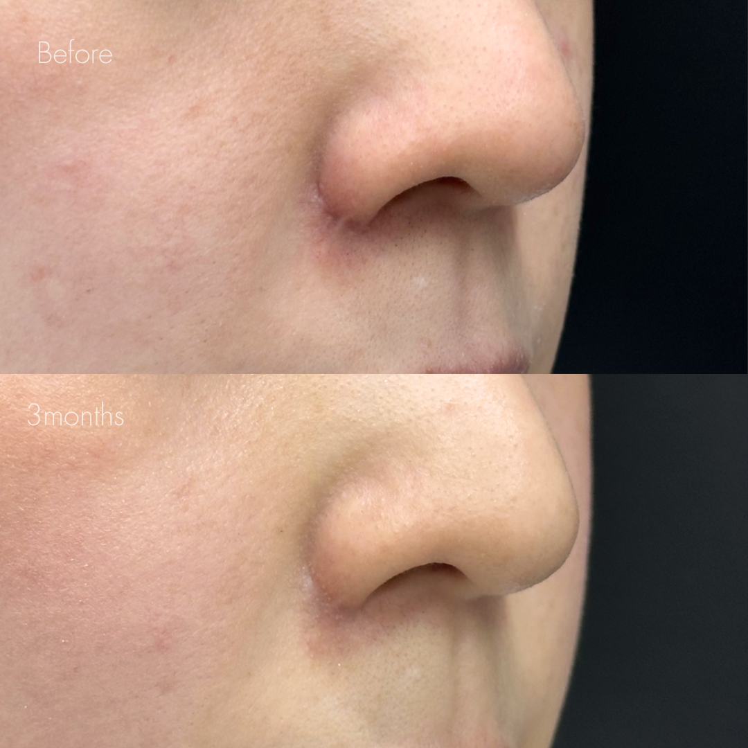 鼻翼縮小後の傷跡修正（グラデーション加工）