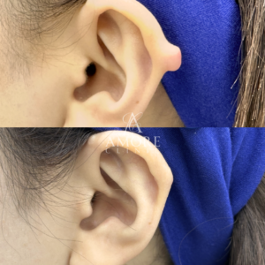 ケロイド除去（切開法）