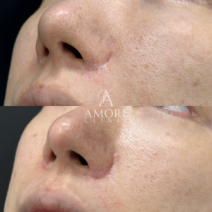 人中短縮後の傷跡修正（グラデーション加工）