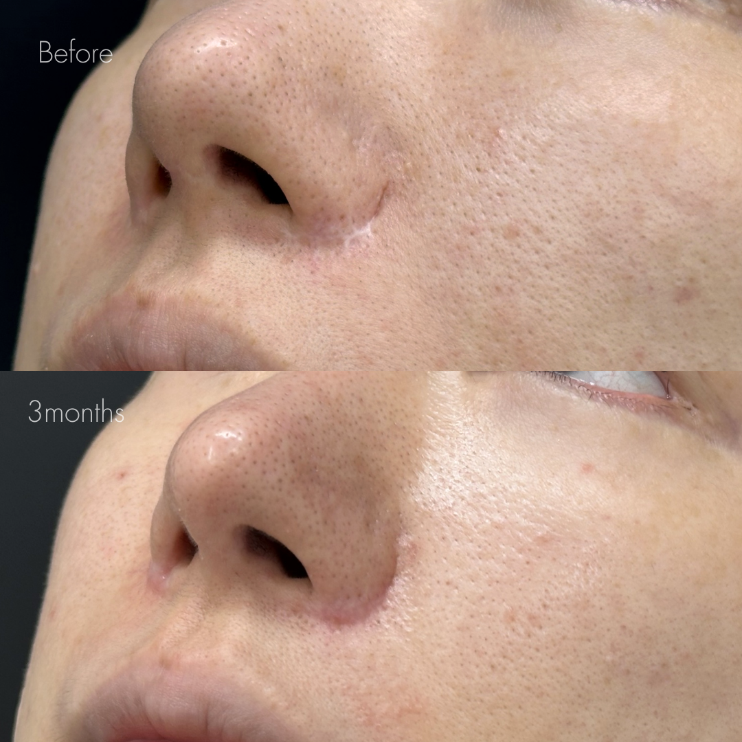 人中短縮後の傷跡修正（グラデーション加工）