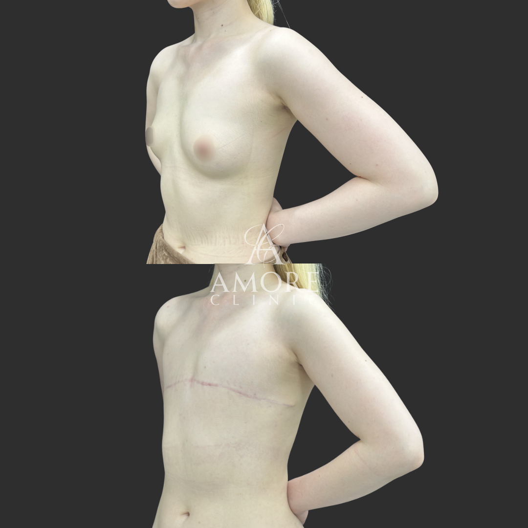 乳房全切除