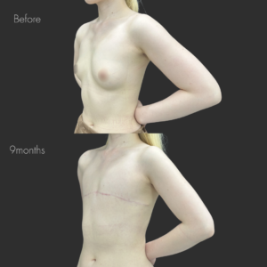 乳房全切除