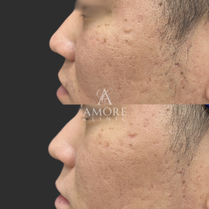 プロテーゼ挿入・鼻尖縮小・耳介軟骨移植・鼻翼縮小・鼻翼挙上