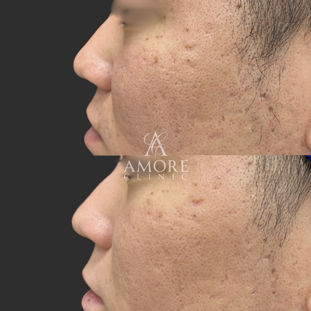 プロテーゼ挿入・鼻尖縮小・耳介軟骨移植・鼻翼縮小・鼻翼挙上