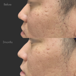 プロテーゼ挿入・鼻尖縮小・耳介軟骨移植・鼻翼縮小・鼻翼挙上