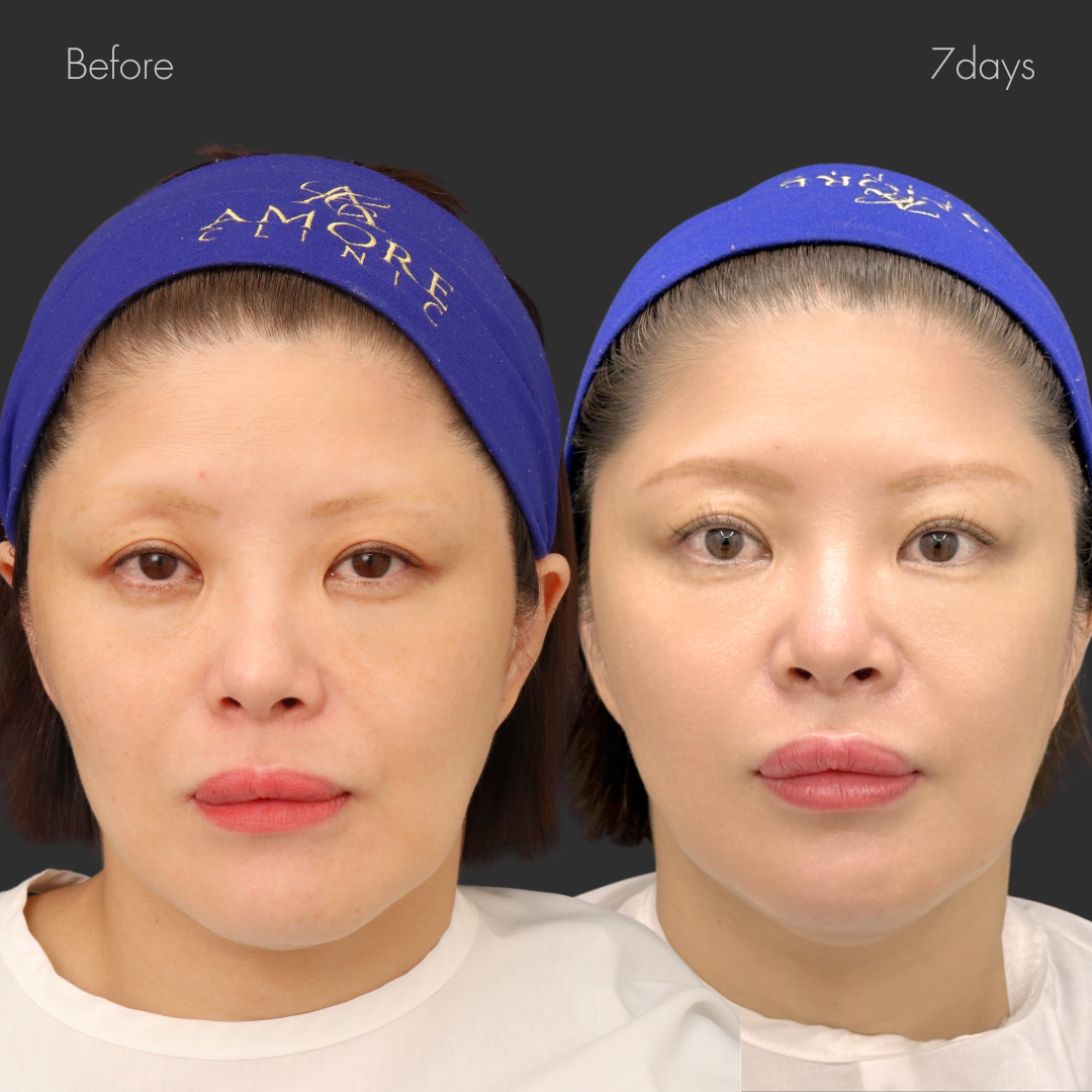 ポニーテールリフト