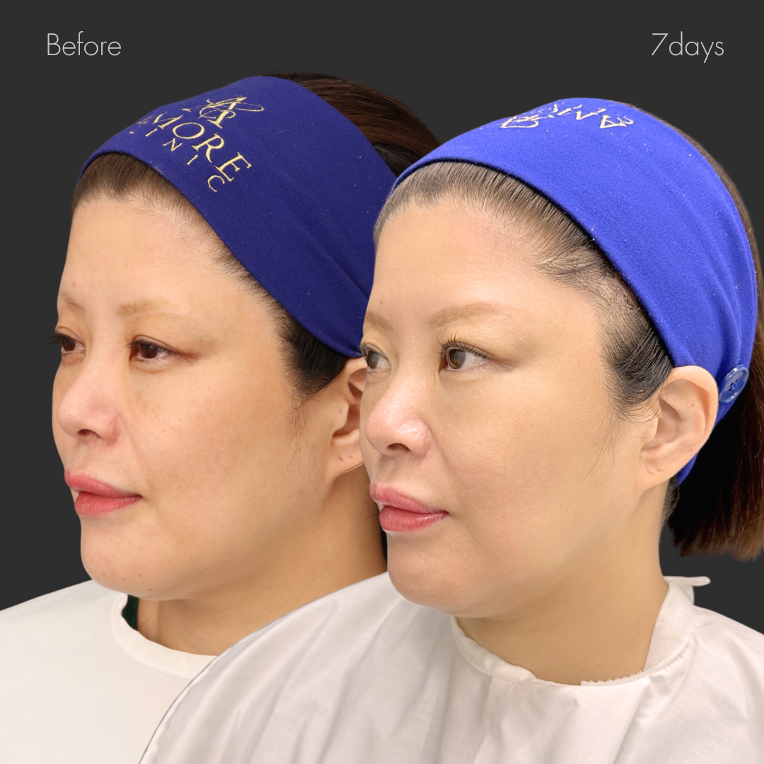 ポニーテールリフト