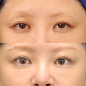 ポニーテールリフト