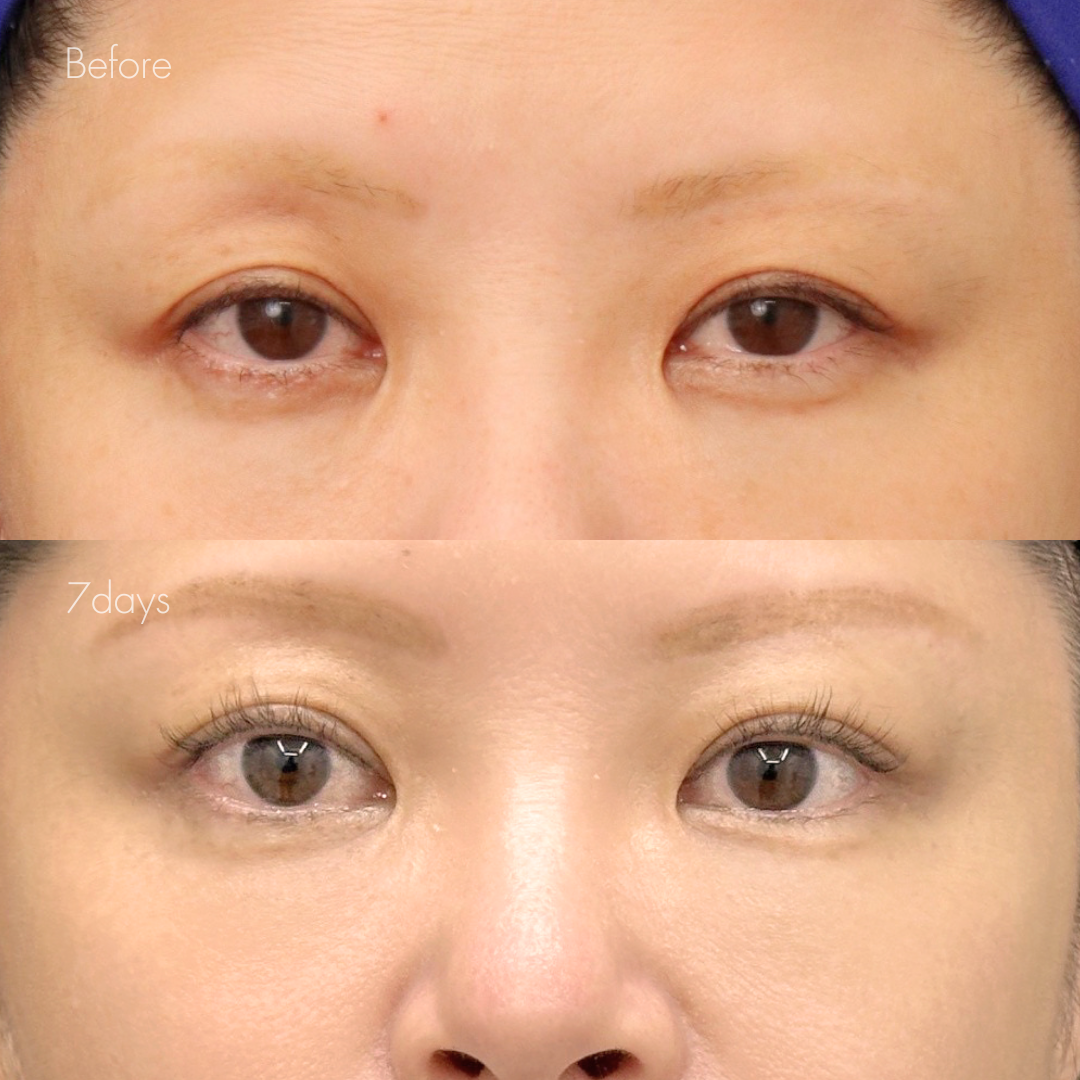 ポニーテールリフト