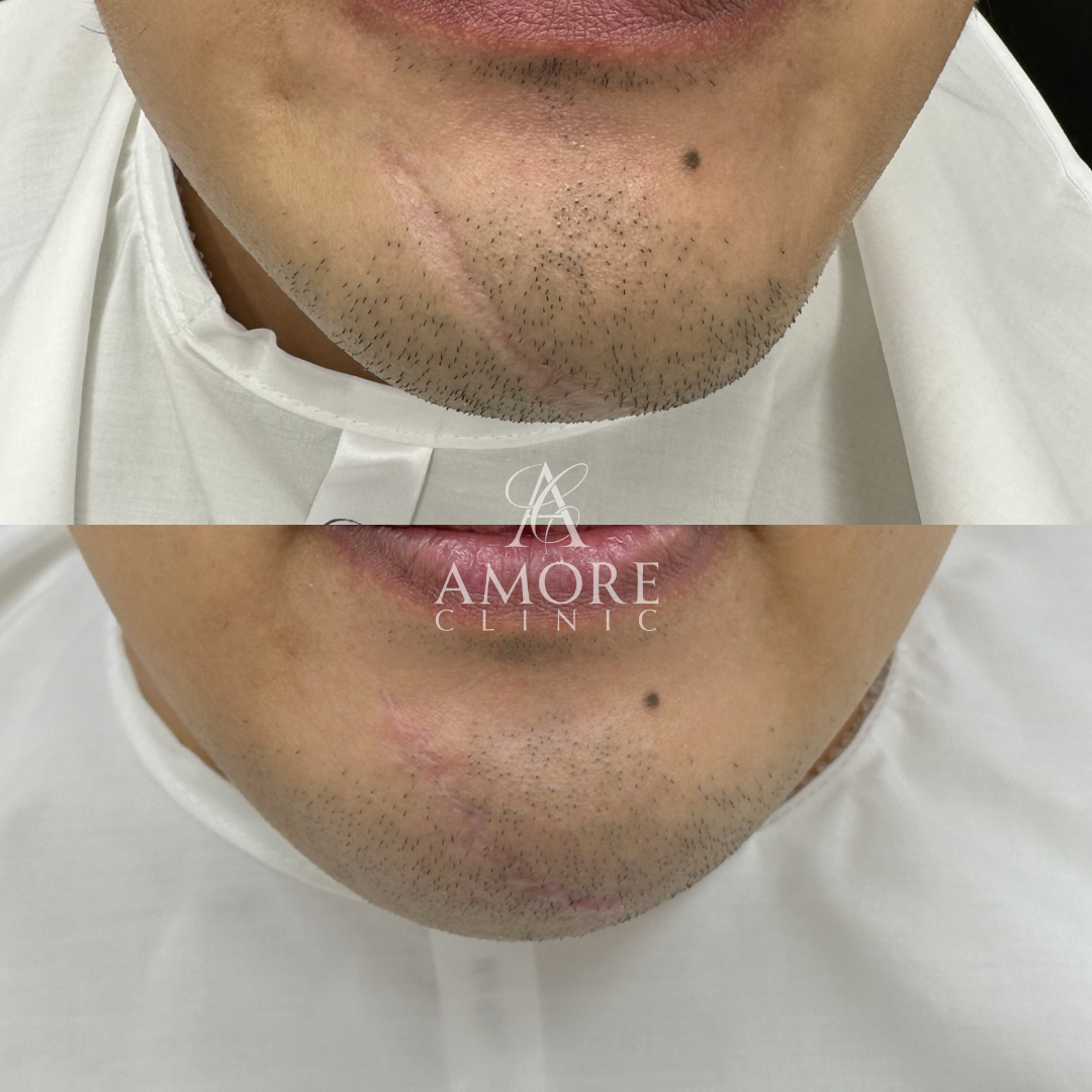 傷跡修正（切開法）