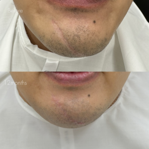 傷跡修正（切開法）