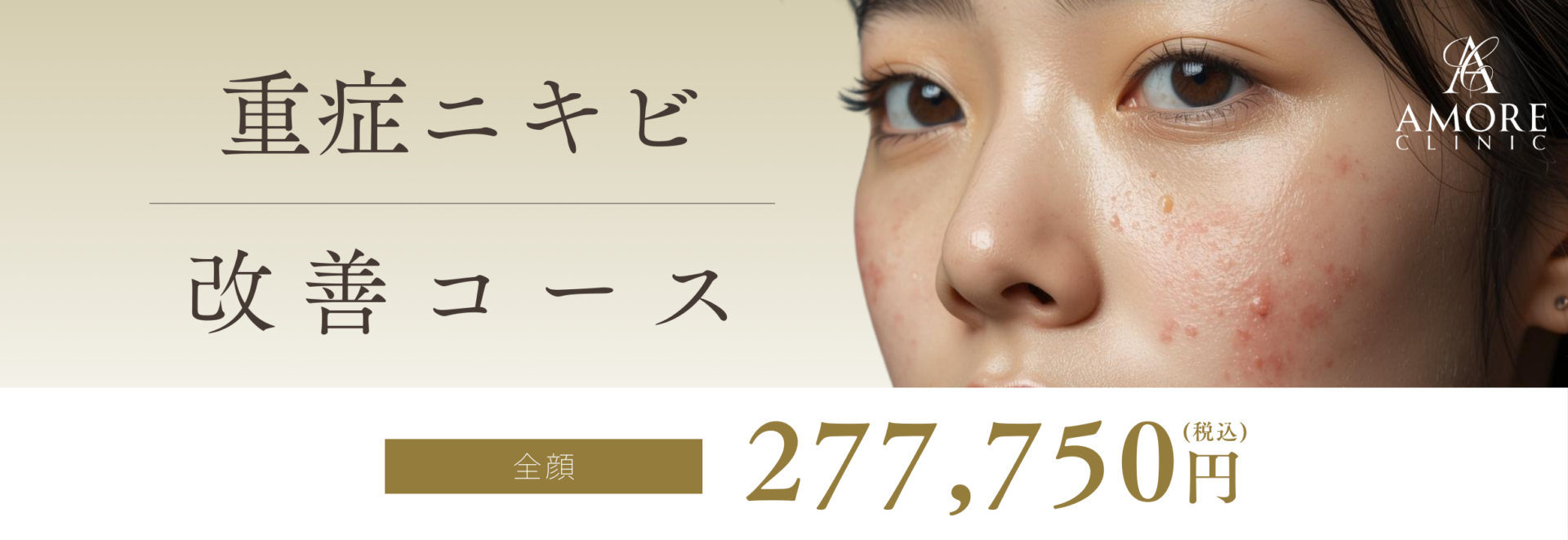 重症ニキビ改善コース