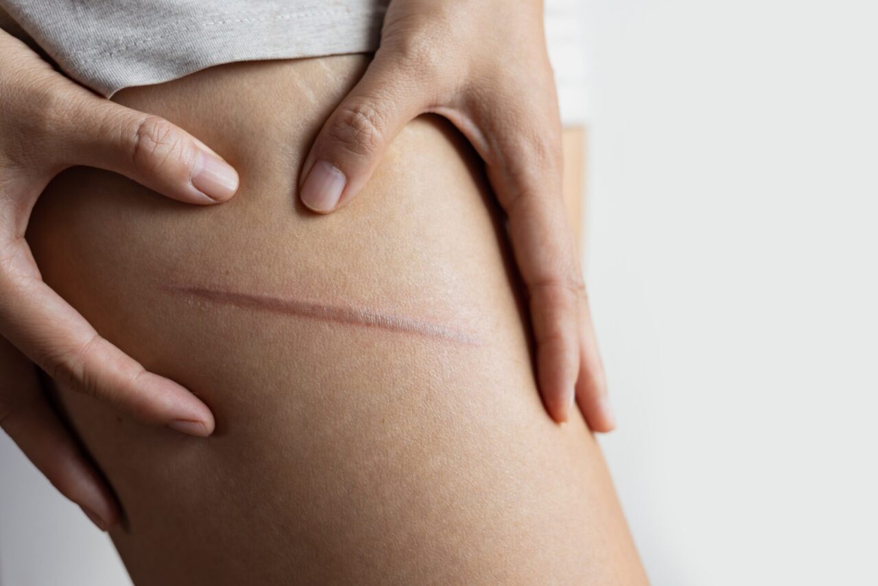 【医師監修】傷跡レーザー治療の全て｜種類・効果・ダウンタイムを徹底解説