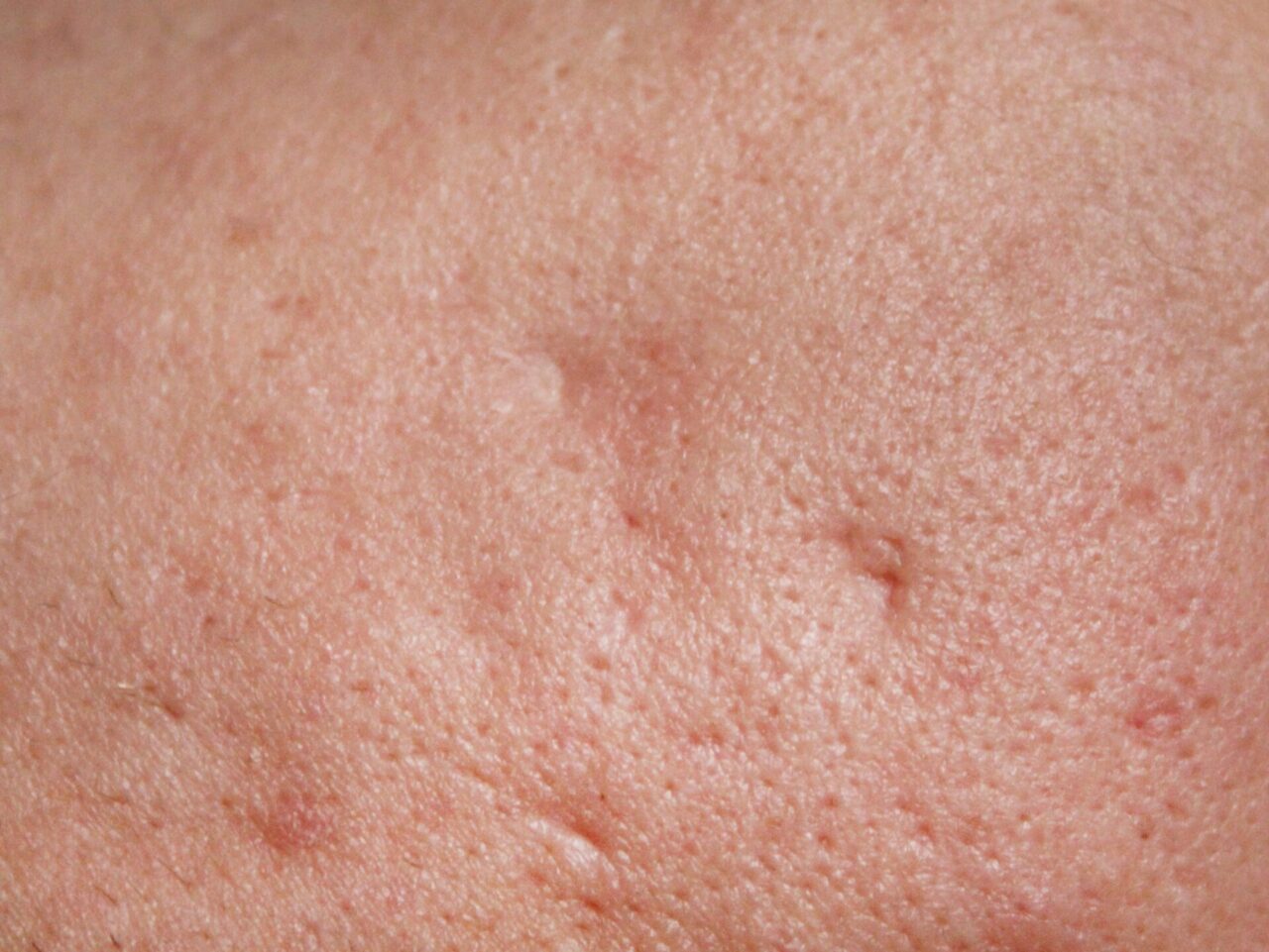 サブシジョン+ヒアルロン酸