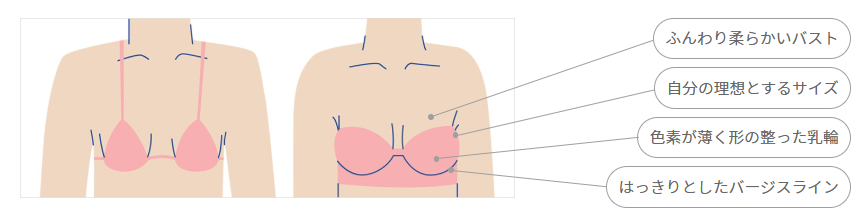 シリコンバッグ豊胸