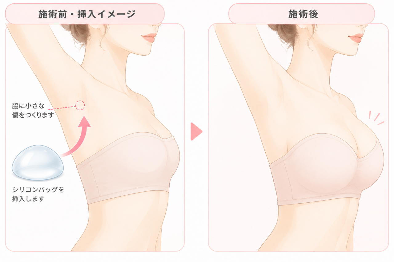 シリコンバッグ豊胸
