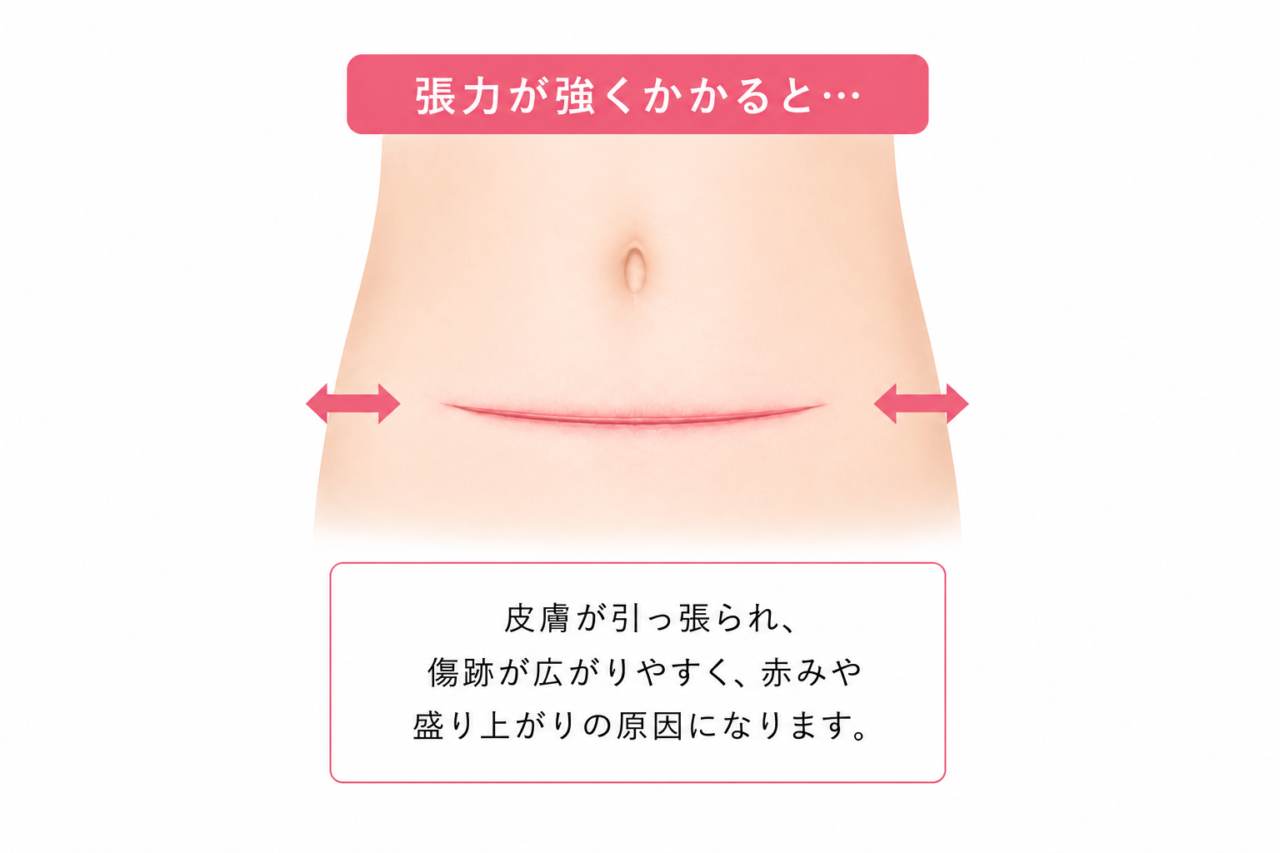 妊娠線・帝王切開傷跡修正