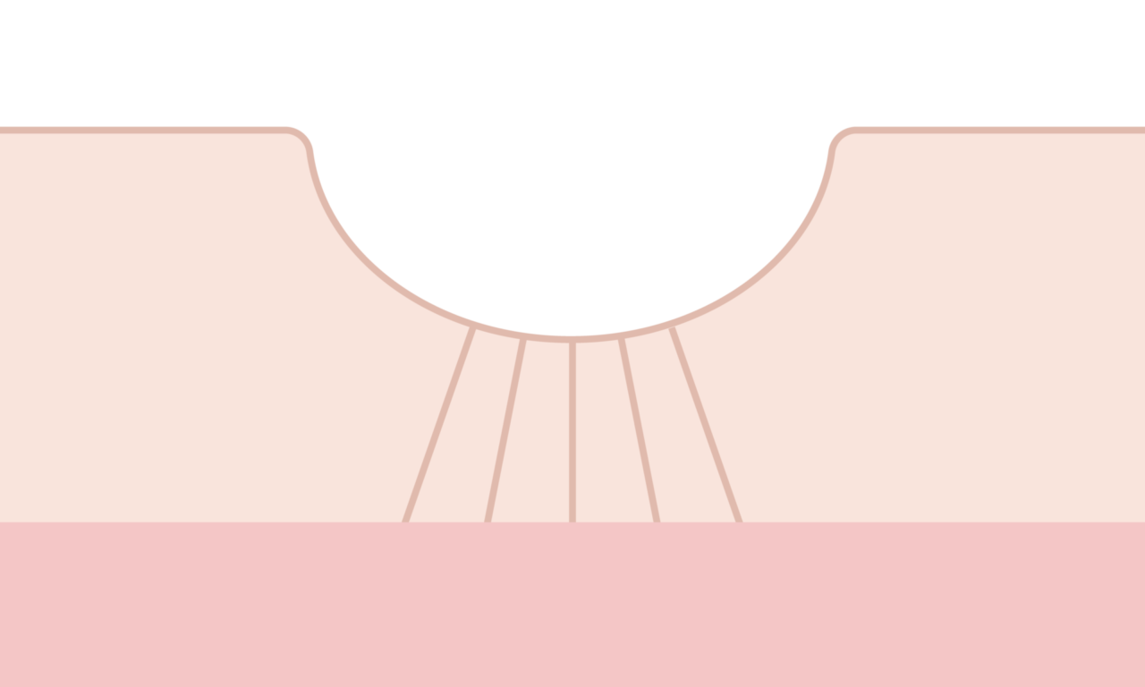 サブシジョン+ヒアルロン酸