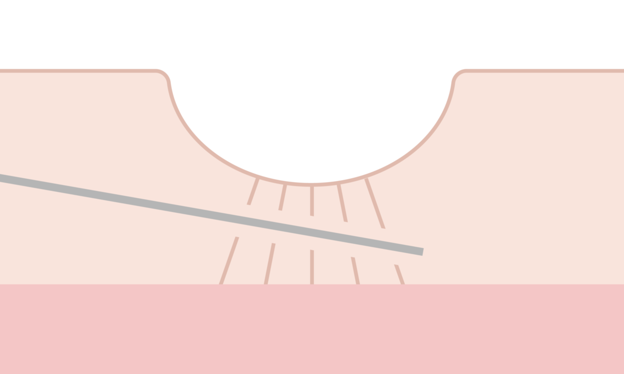 サブシジョン+ヒアルロン酸